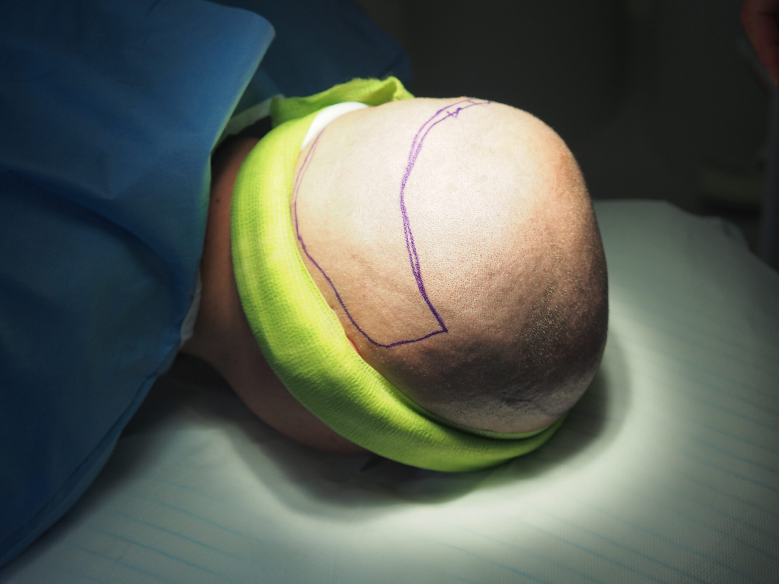 Pozycja do pobierania graftów