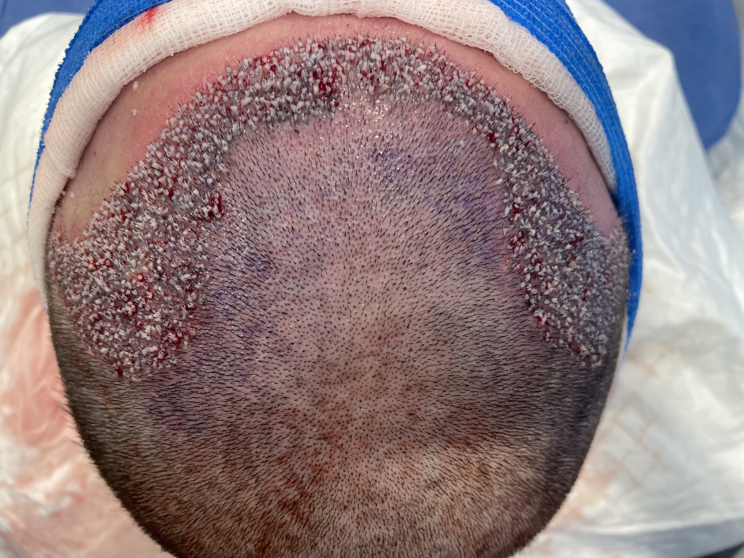 Zabieg 2000 graftów