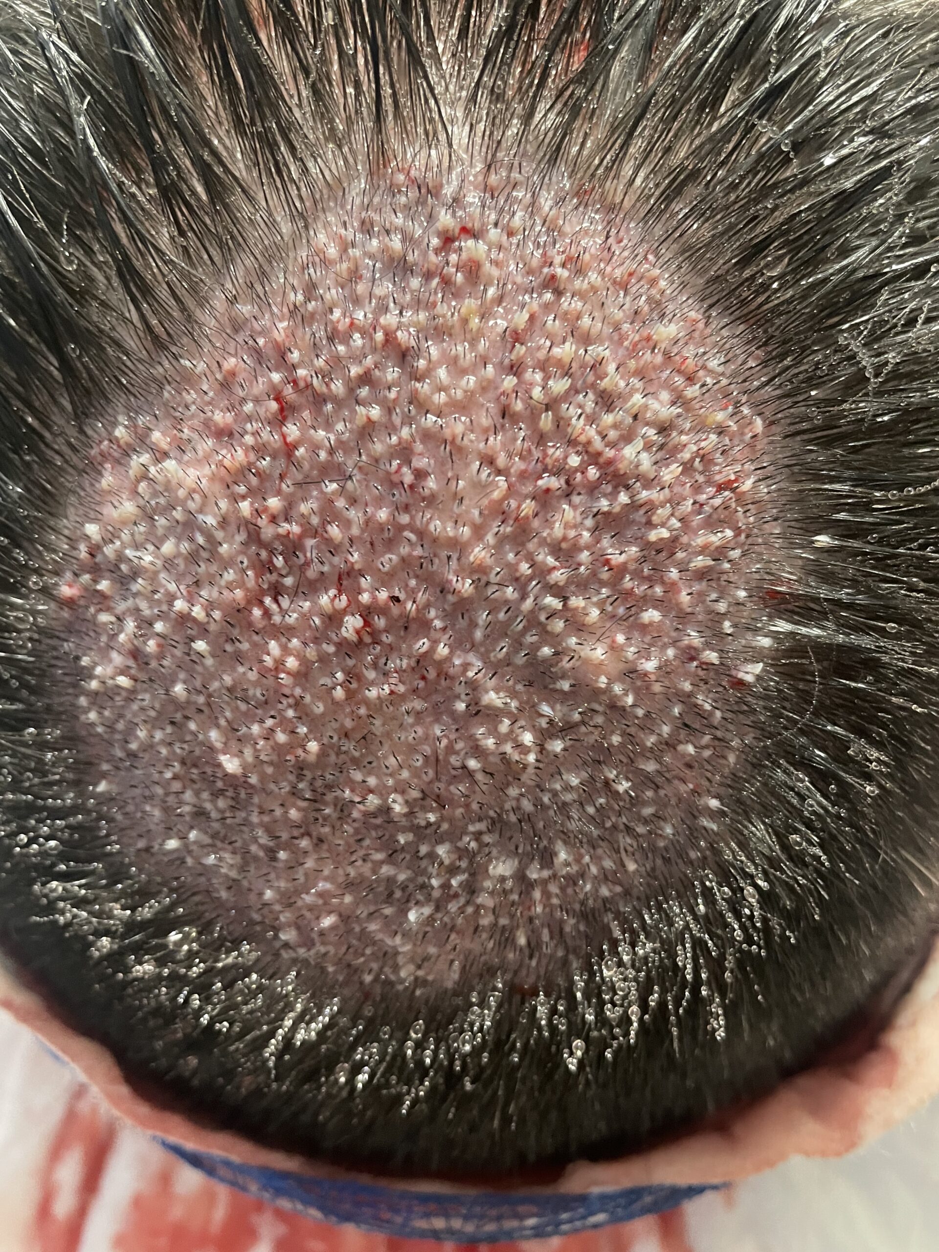 Zabieg 2600 graftów