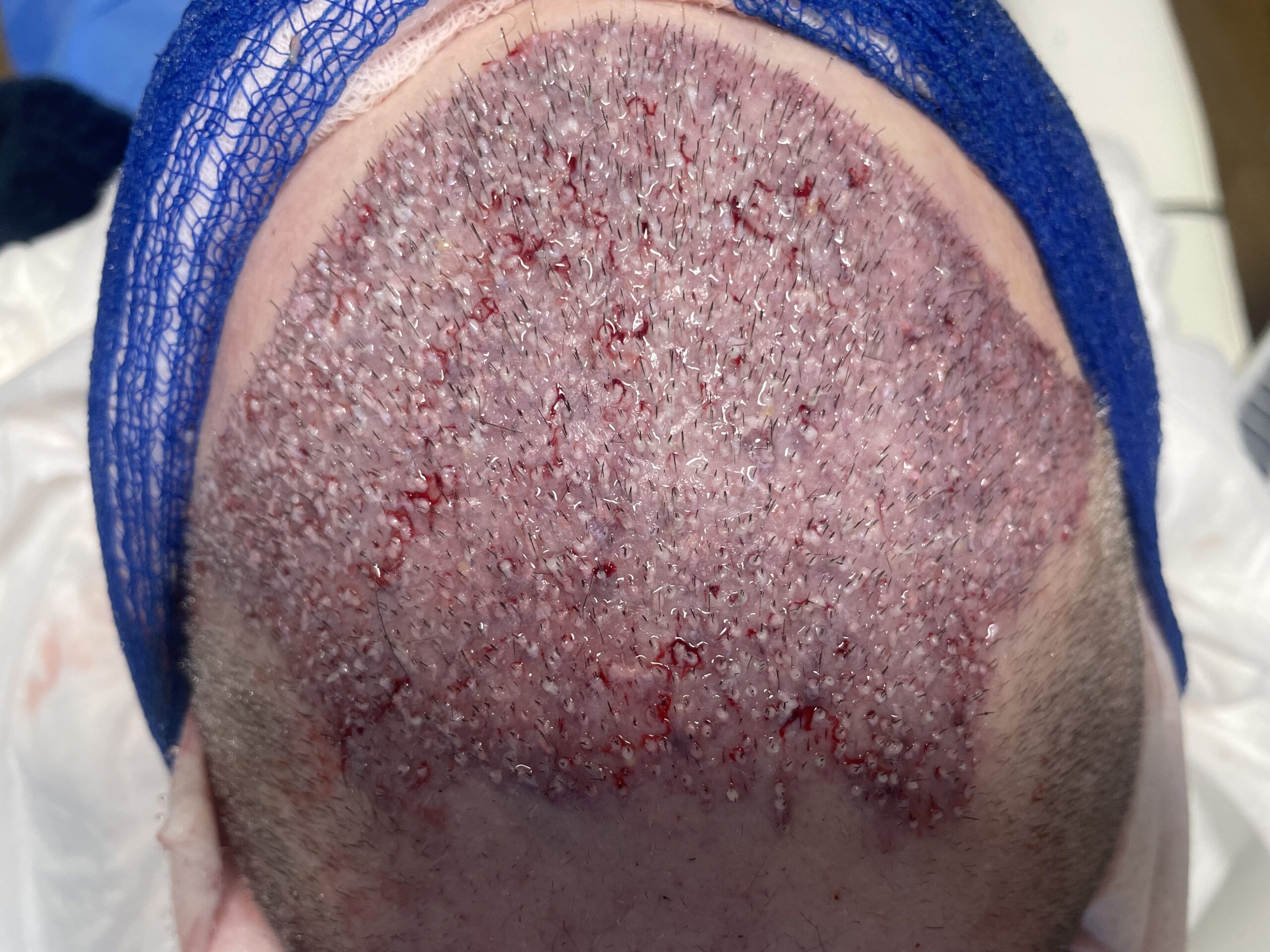 Zabieg 2750 graftów