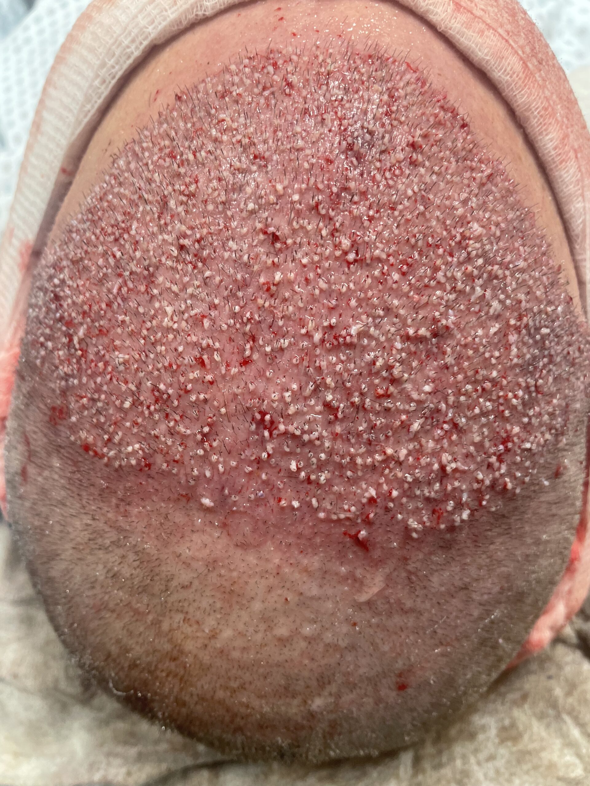 Zabieg 2950 graftów