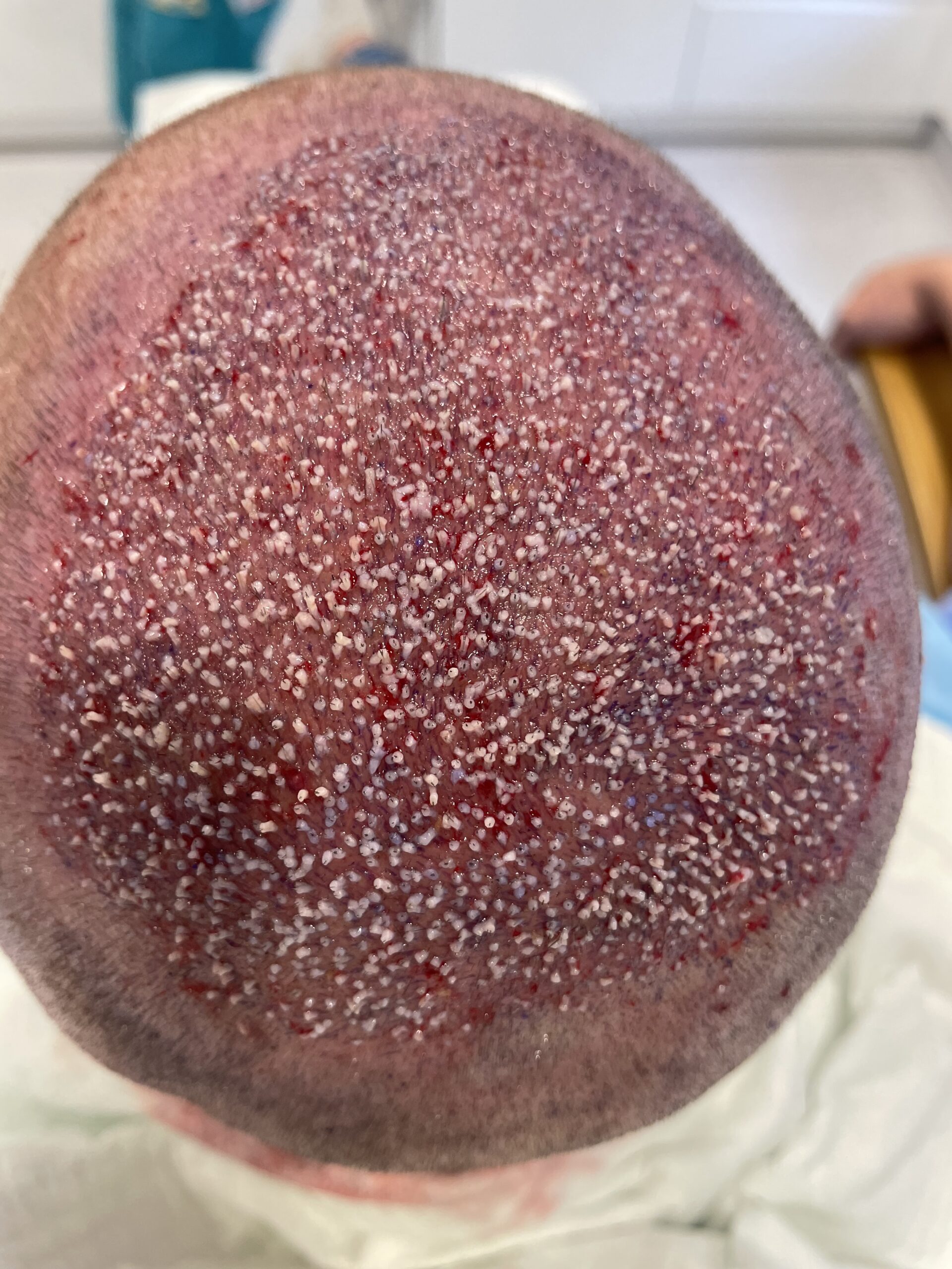 Zabieg 3000 graftów