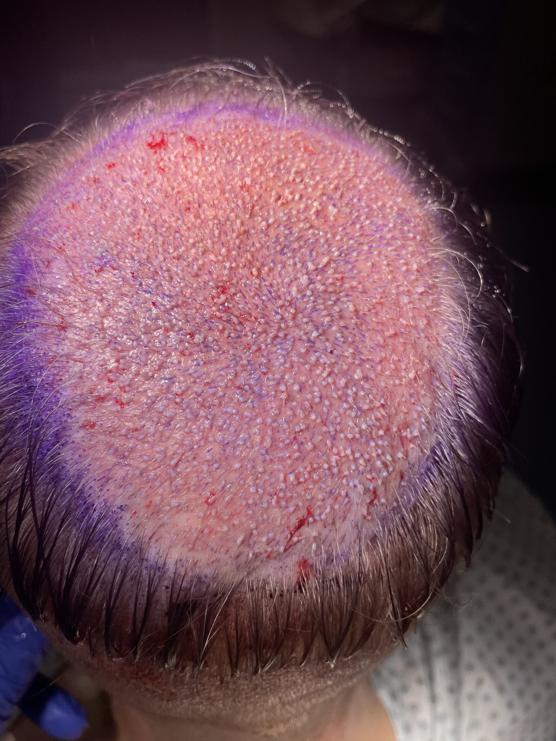 Zabieg 3500 graftów