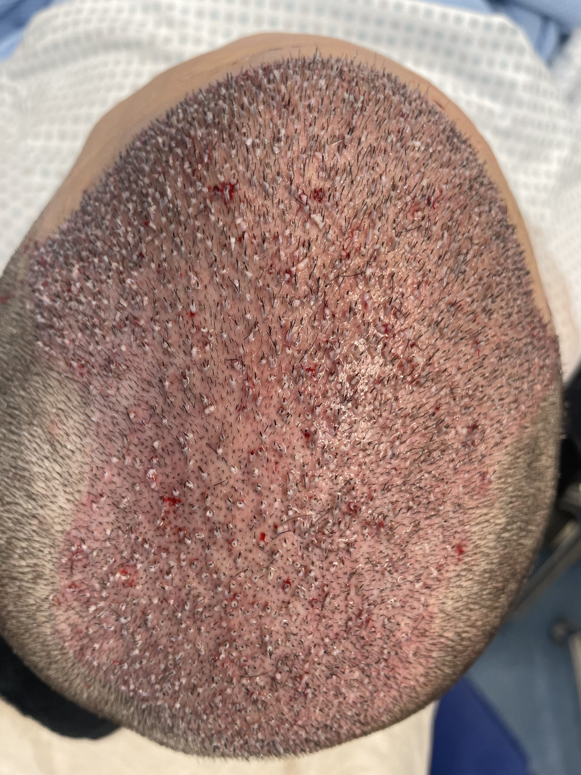 Zabieg 3650 graftów