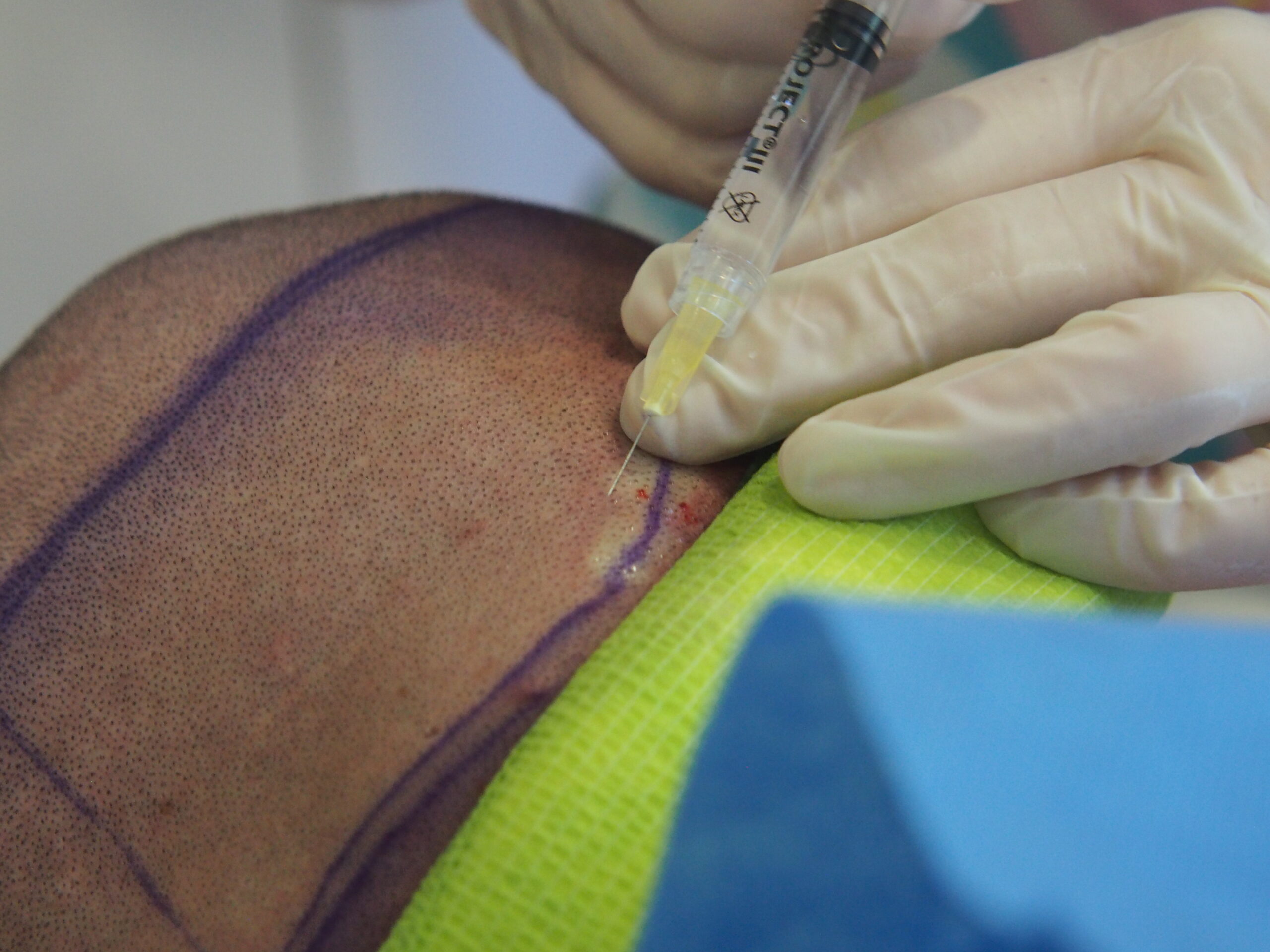 Znieczulenie przed zabiegiem