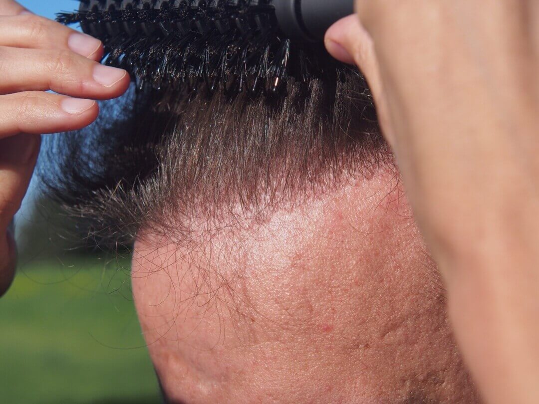 Maritime Hair Center - Przeszczep włosów w Gdańsku